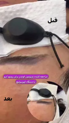 حذف تتوی ابرو 