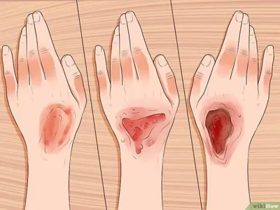 بهترین کارشناس زخم در منزل اصفهان