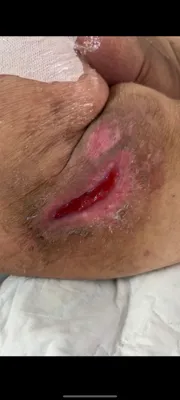 درمان زخم در اصفهان