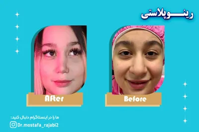 عمل زیبایی بینی در اصفهان