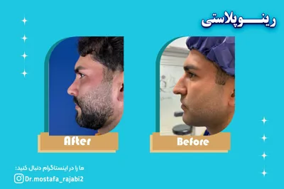 عمل زیبایی بینی در شهر اصفهان