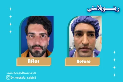 عمل زیبایی بینی در اصفهان