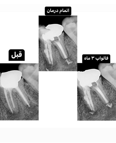 درمان مجدد دندان مولر اول فک پایین با تحلیل داخلی و وسعت ضایعه بسیار، تمامی کانال ها به صورت کامل با سرامیک سرد ابچوره شد.