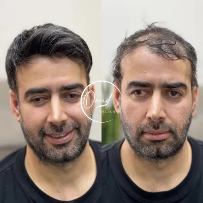 پروتز مو شهرضا