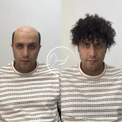 پروتز مو شهرضا