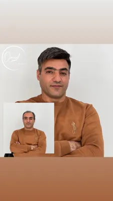 پروتز مو شهرضا