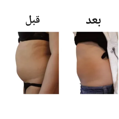 امبدینگ برای لاغری شکم