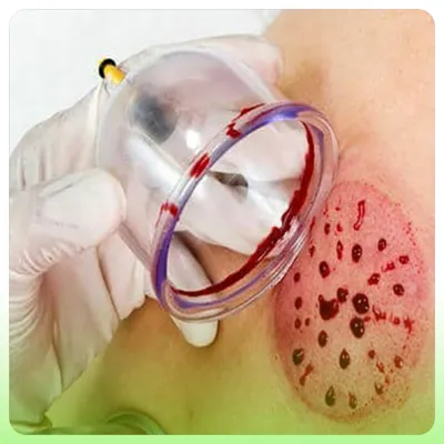 حجامت دوکتف