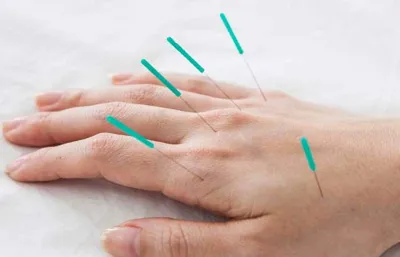 طب سوزنی دست