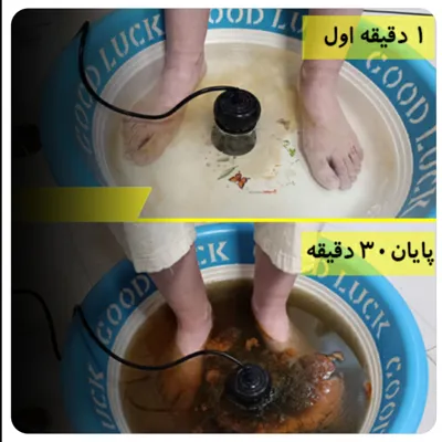 سم زدای بدن با دستگاه