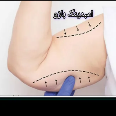 امبدینگ  بازو