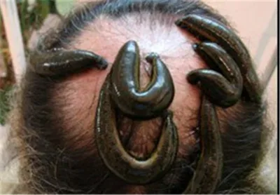 زالو درمانی سر