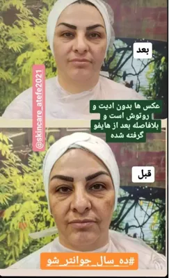 هایفو تراپی هفت بعدی 