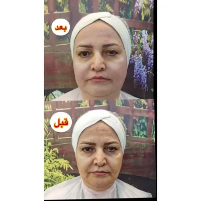 رفع خط لبخند با هایفو تراپی