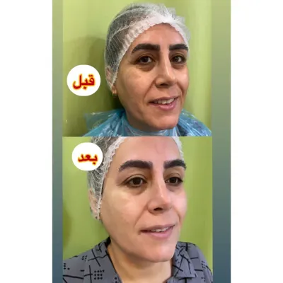 جوانسازی با هایفو هفت بعدی 