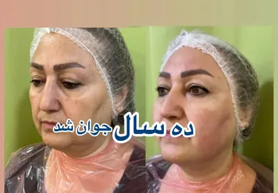 جوانسازی با دستگاه جوانساز هایفو