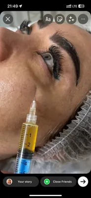 جوانسازی با پی آر پی