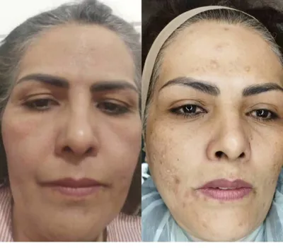 رفع لک و منافذ باز پوست