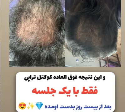 کوکتل تراپی در شیراز