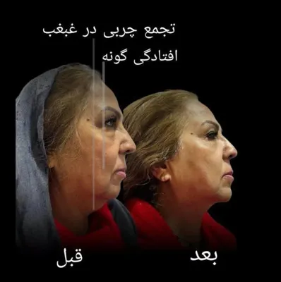 رفع غبغب و افتادگی گونه شیراز
