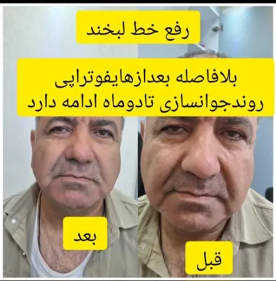 جوانسازی پوست 