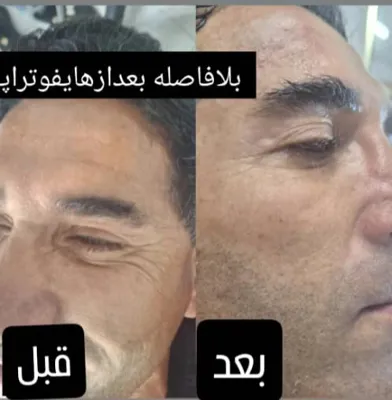 هایفوتراپی در شیراز