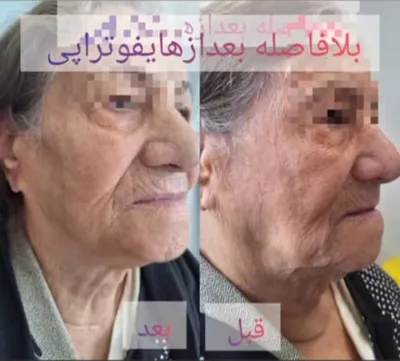 رفع افتادگی پوست با هایفو