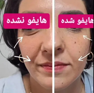 کاهش چین و چروک با هایفوتراپی