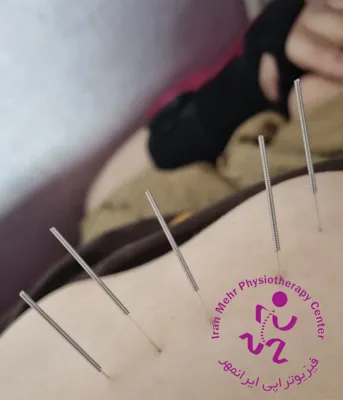 آزاد سازی بافت و رفع تریگرپوینت