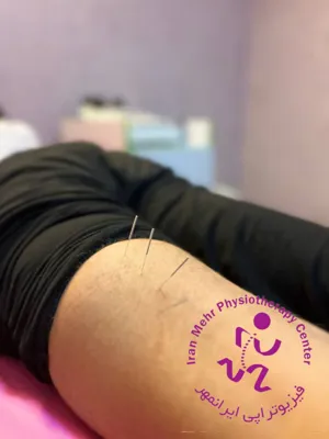 طب سوزنی در پا