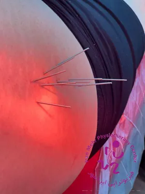 طب سوزنی 