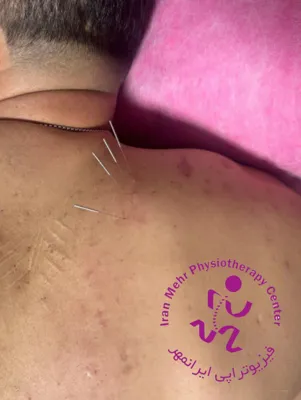 آزاد سازی بافت و رفع تریگرپوینت