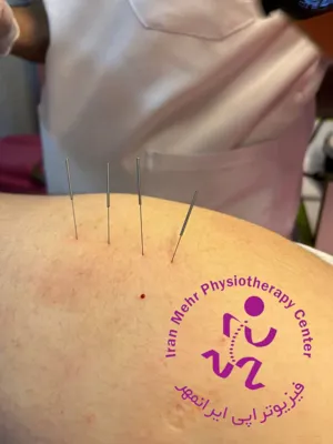 آزادسازی بافت و رفع تریگرپوینت