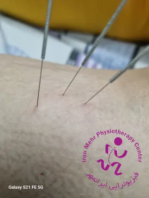 طب سوزنی در ماهیچه پا