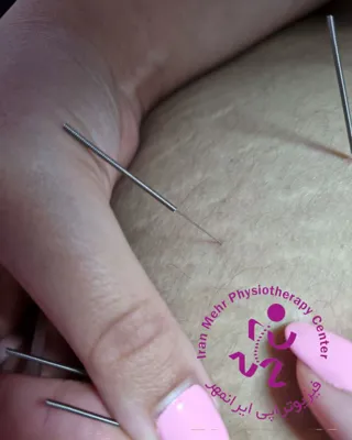 آزادسازی بافت و رفع تریگرپوینت