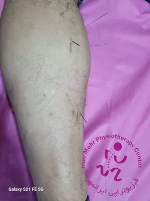 طب سوزنی در ماهیچه پا