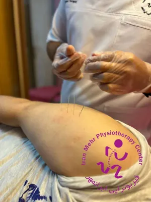 طب سوزنی در بازو