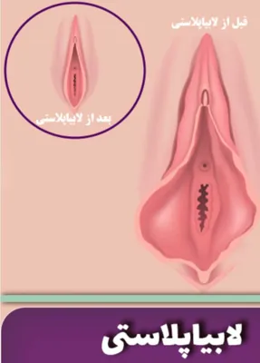 جراحی پرده بکارت در خرم اباد