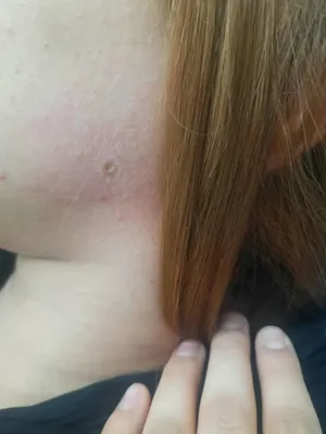 برداشتن ضایعه پوستی در هشتگرد