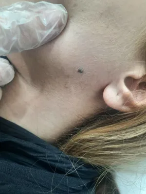 برداشتن خال گوهردشت