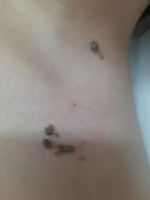 ریمو تتو با لیزرهشتگرد 