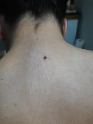 ریمو تتو با لیزرهشتگرد 