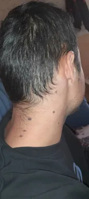 ریمو تتو با لیزرهشتگرد 