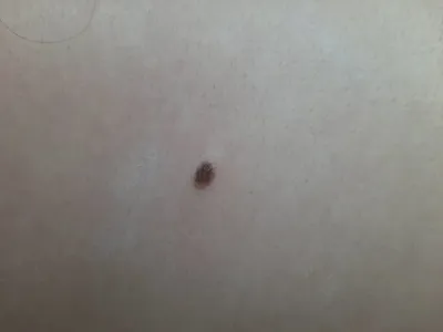 ریمو تتو با لیزرهشتگرد 