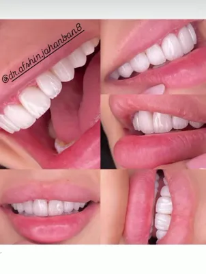 دندان پزشکی برای ایمپلنت دندان در شریعتی 