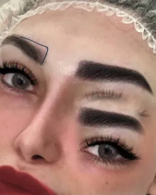 کاشت ابروبدون جراحی