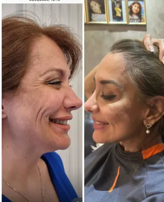 جراح زیبایی بینی در اصفهان