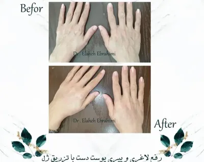 تزریق فیلر دست