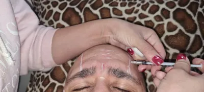 بوتاکس پیشانی