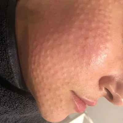  انجام مزوتراپی کل صورت در هانیل
